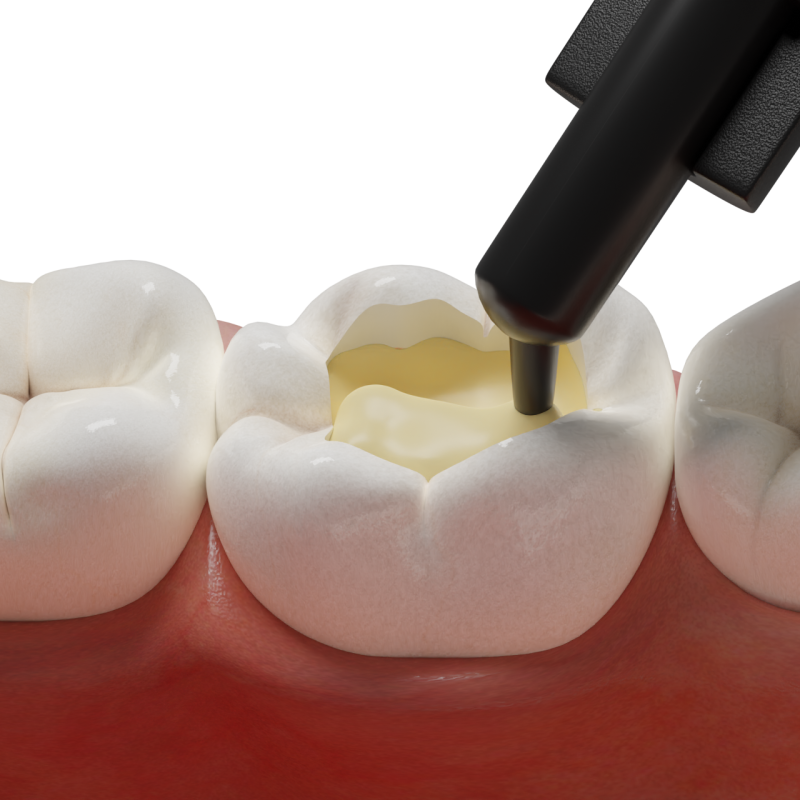 Dentin Replacement with Short-Fiber-Reinforced Composites