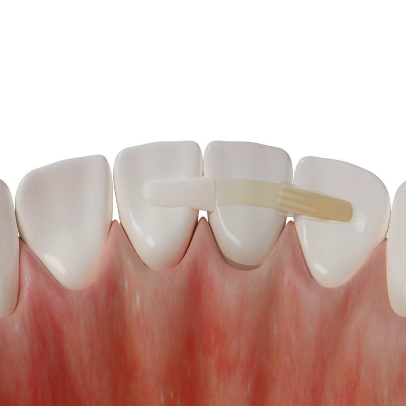Adhesive Anterior Bridge with Fiber-Reinforced Framework