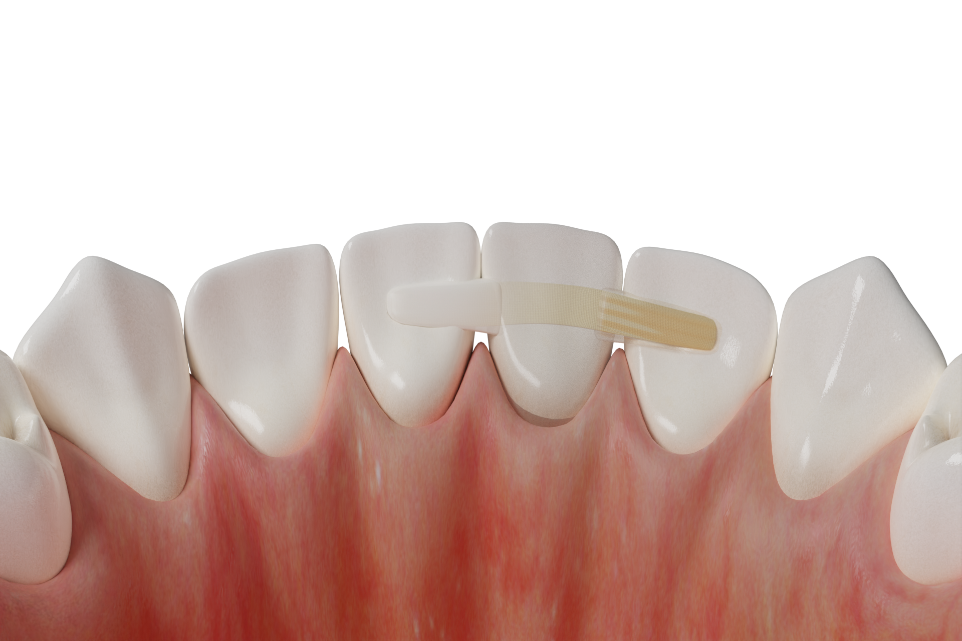 Adhesive Anterior Bridge with Fiber-Reinforced Framework