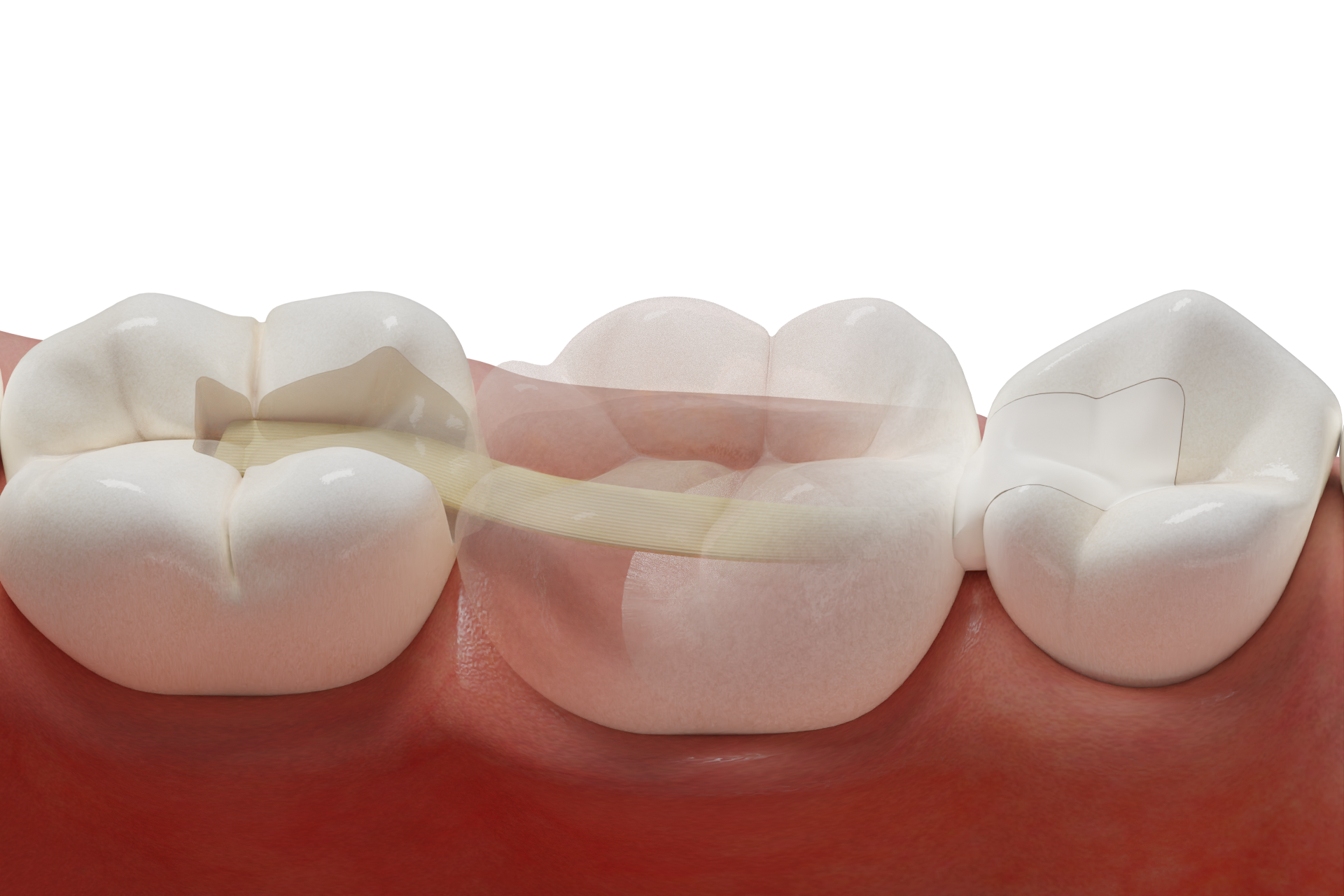 Adhesive Posterior Bridge with Fiber-Reinforced Framework