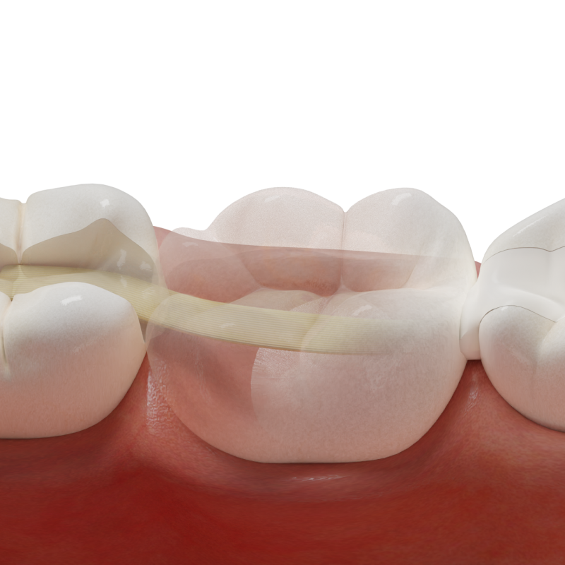 Adhesive Posterior Bridge with Fiber-Reinforced Framework