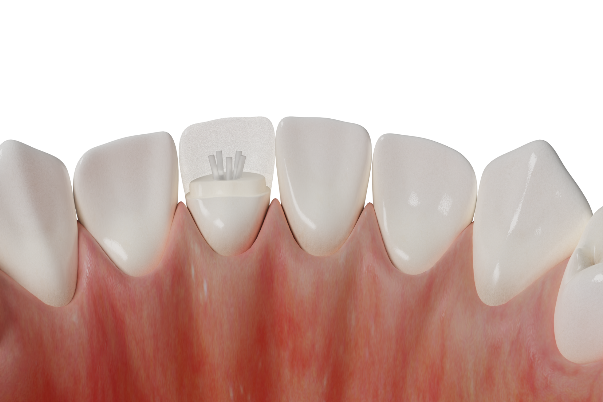 Crown Retention with Flexible Pins