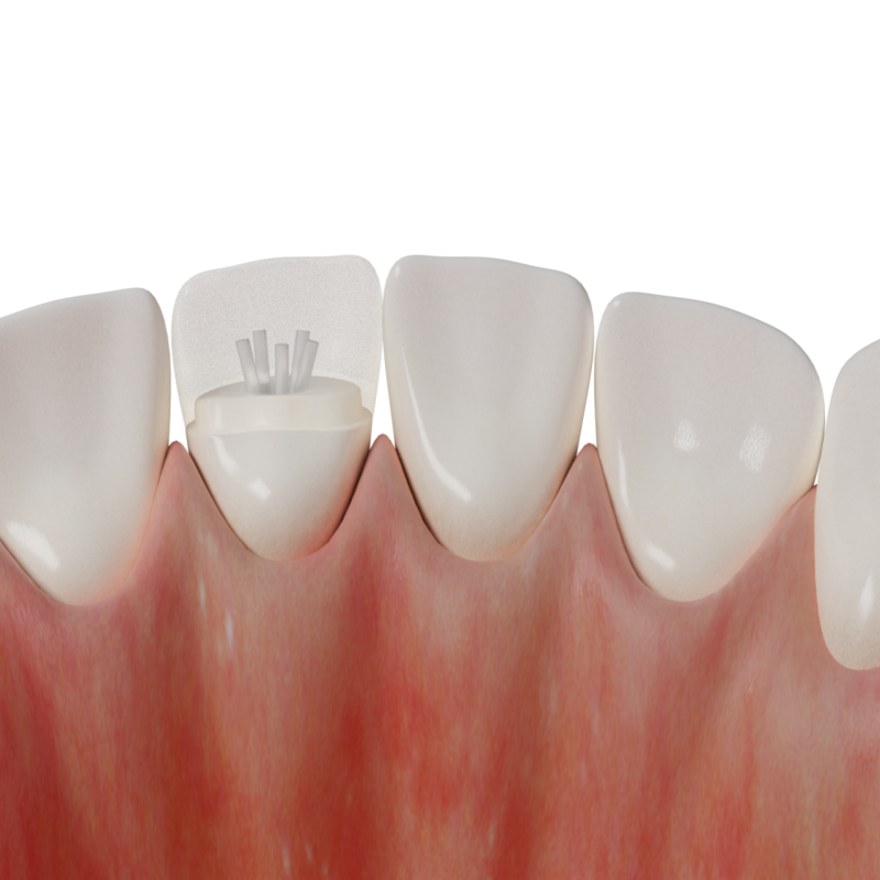 Crown Retention with Flexible Pins