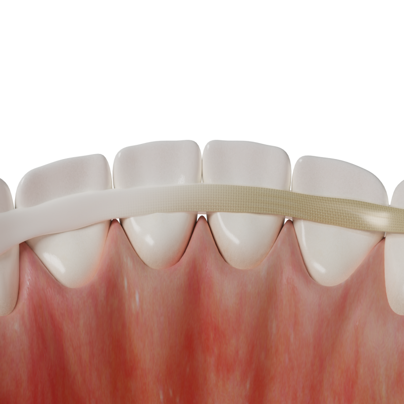 Splinting with Glass-Fiber Reinforcement